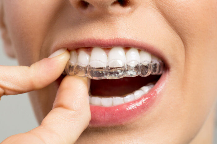 The Purpose Behind Braces