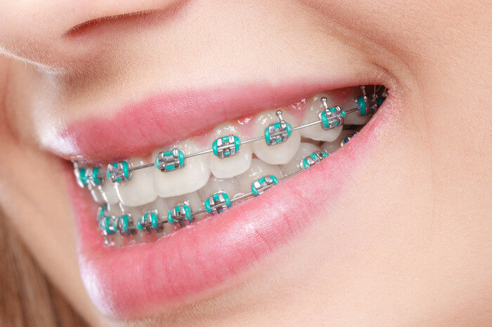 Types of Braces Offered