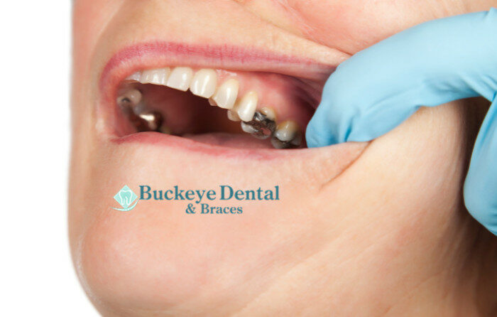 Preventative Dentistry Helps Fight Tooth Decay