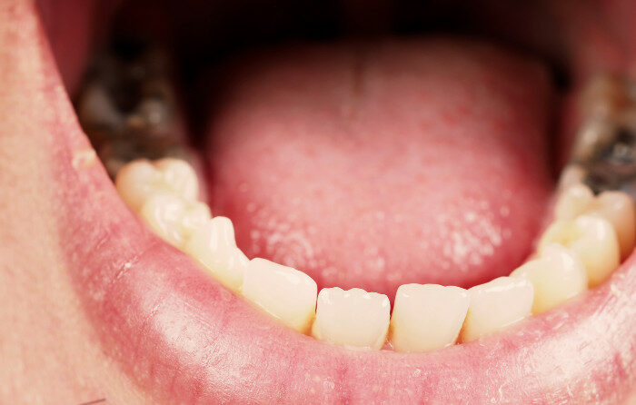 Understanding Tooth Decay and Its Impact