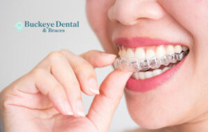 Care for Your Braces in Detroit Climate