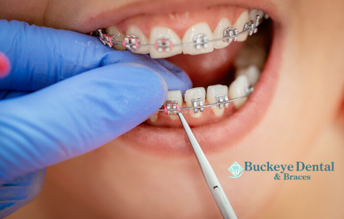 Protecting Your Braces During Physical Activity