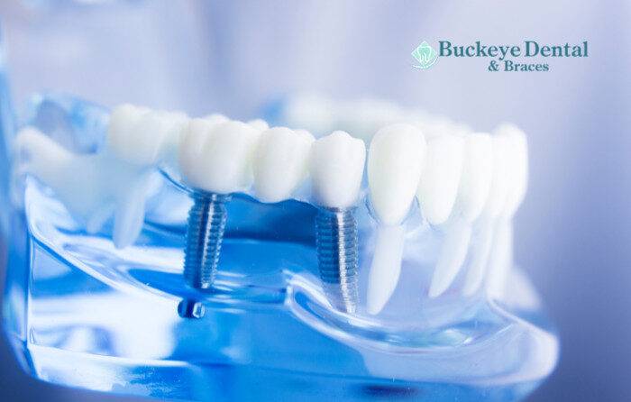 Types of Cosmetic Dentistry Treatments