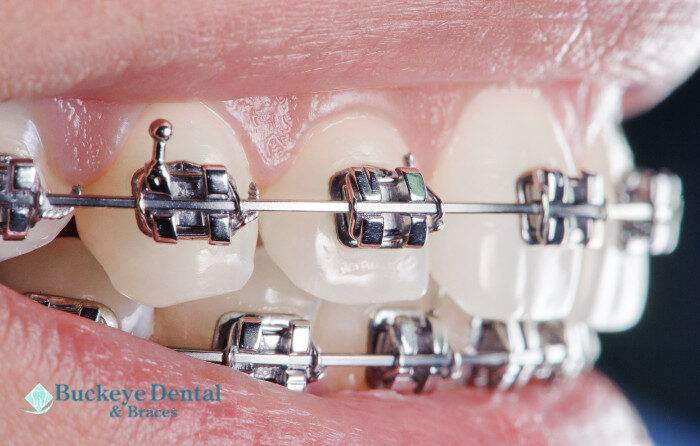 Get Straighter Teeth Without Braces