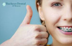 How to Care for Your Teeth with Braces Cleveland