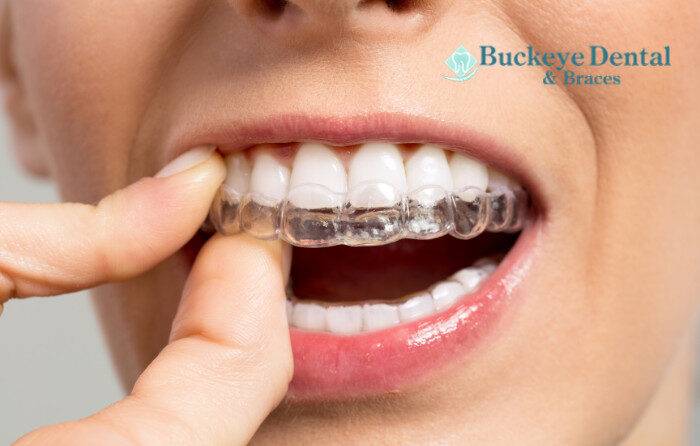 braces-cleveland-ohio-care