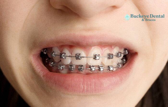 Types of Braces Available