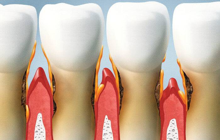 Most Common Reasons Gums Start Bleeding