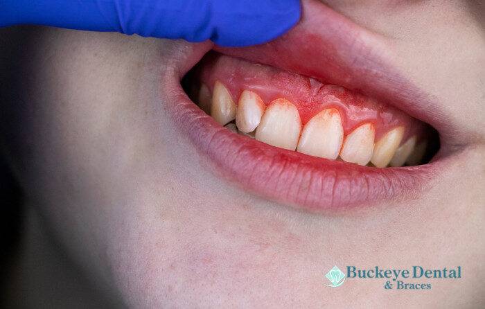What Causes Bleeding Gums And How To Stop It