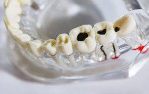 Common Dental Problems and How to Prevent Them