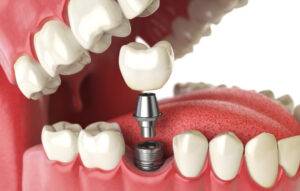 How to Care for Dental Implants for Long-Term Success