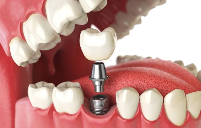 How to Care for Dental Implants for Long-Term Success