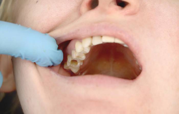 Tooth Decay and Cavities