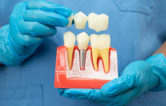 Dental Implants Avon Ohio Patients Trust