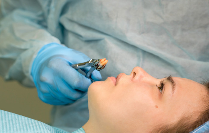 Recovery Time Root Canal vs Tooth Extraction