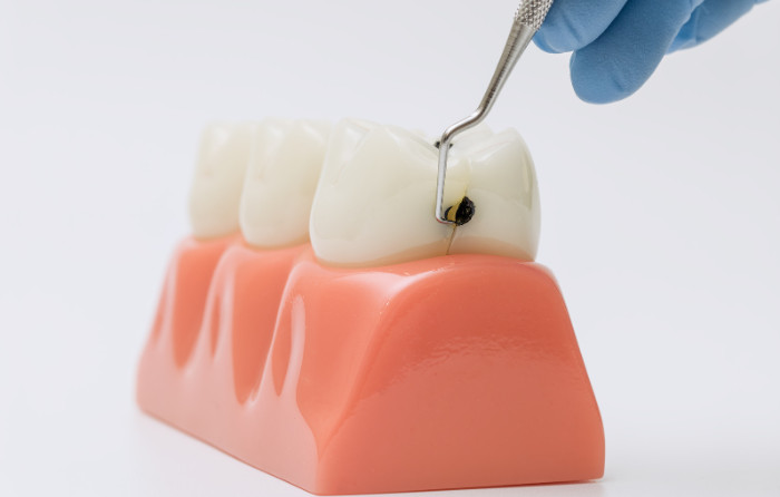 Tooth Decay and Cavities