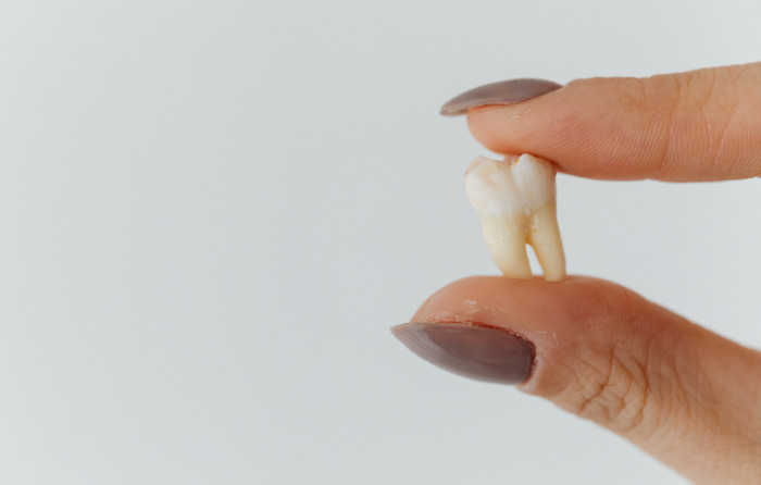 What Is a Tooth Extraction