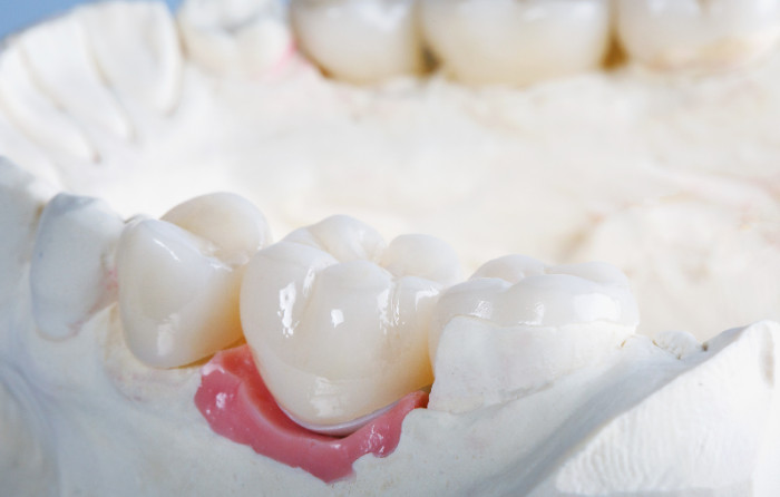 Aftercare Tips for Fillings and Crowns