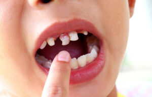 What Foods Are Most Likely to Cause Tooth Decay in Children (2)